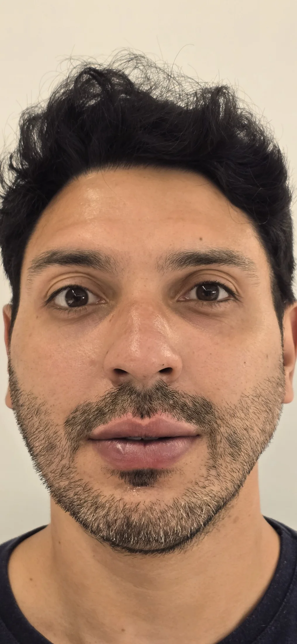 Resultado depois do Botox